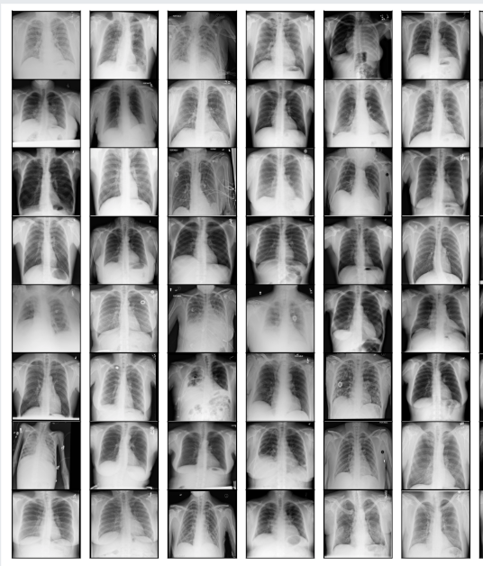 Dataset de radiografías de tórax para entrenamiento de modelos de visión